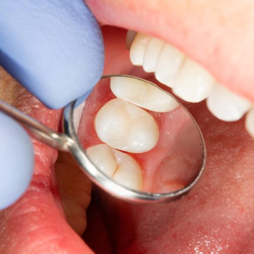 260140-restauracao-de-dente-o-que-e-e-quando-fazer-1