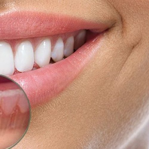 implantes-dentarios-ou-proteses